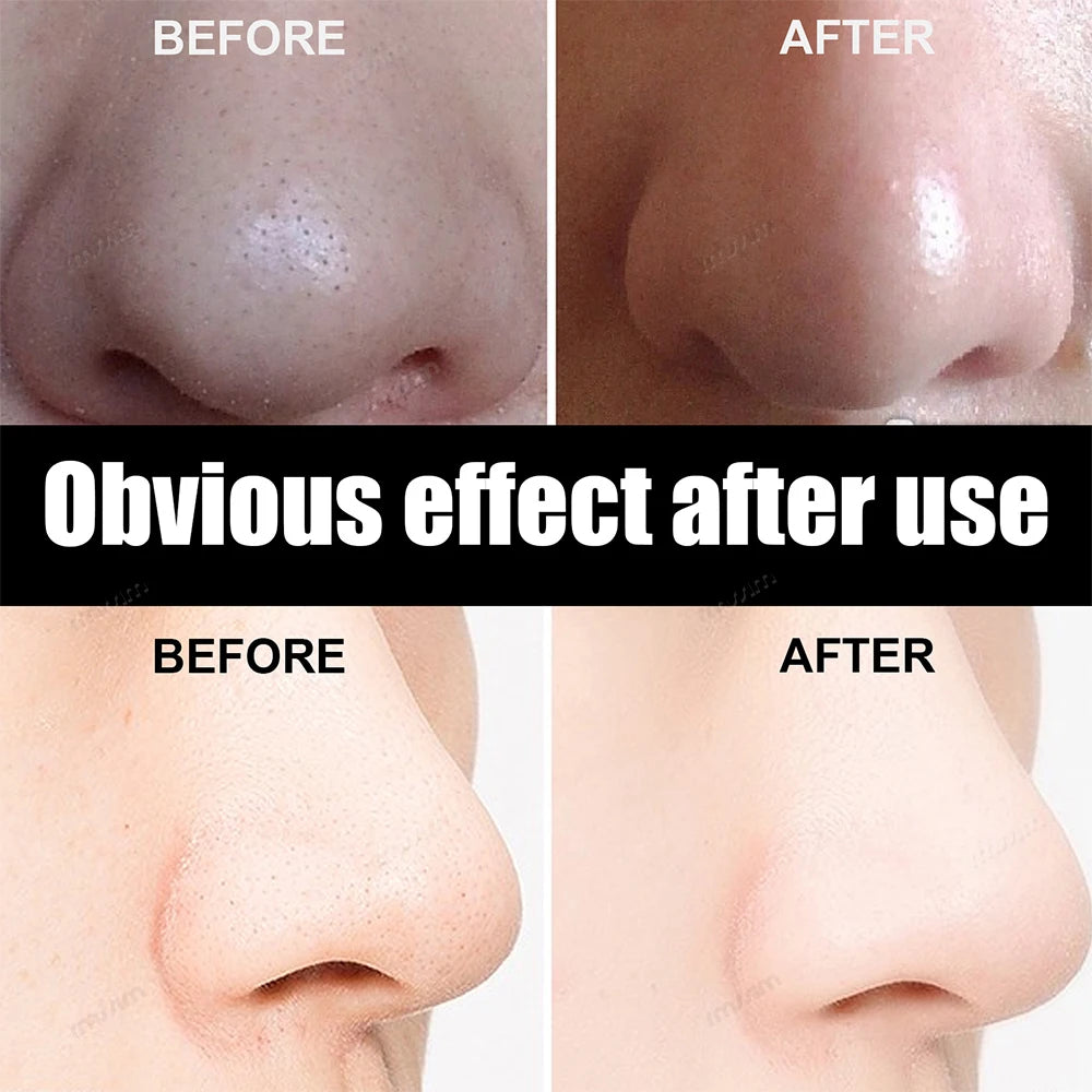 Deep Cleansing Blackhead Removal Nose Strips | Pore Cleaner