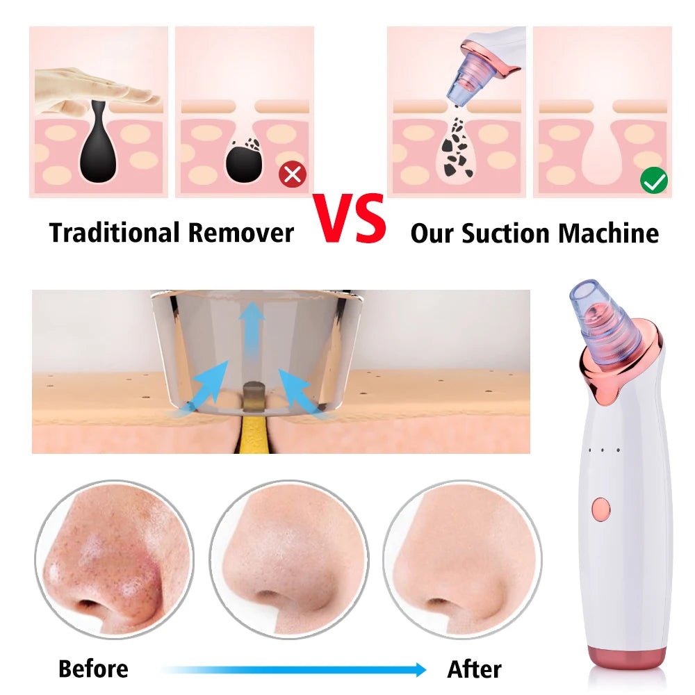 Facial Blackhead Remover | Electric Acne Cleaner | Blackhead Black Point Vacuum Cleaner Tool | Black Spots Pore Cleaner Machine - Glamour Touch