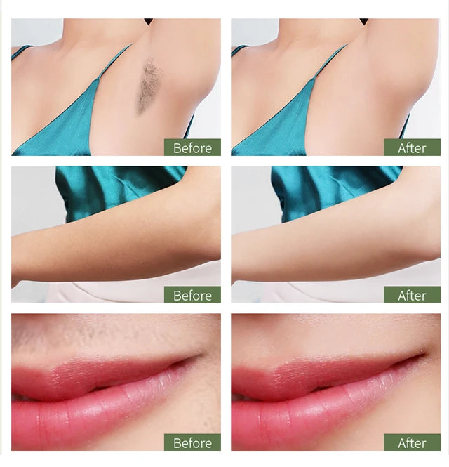 Before and after results of IPL hair removal