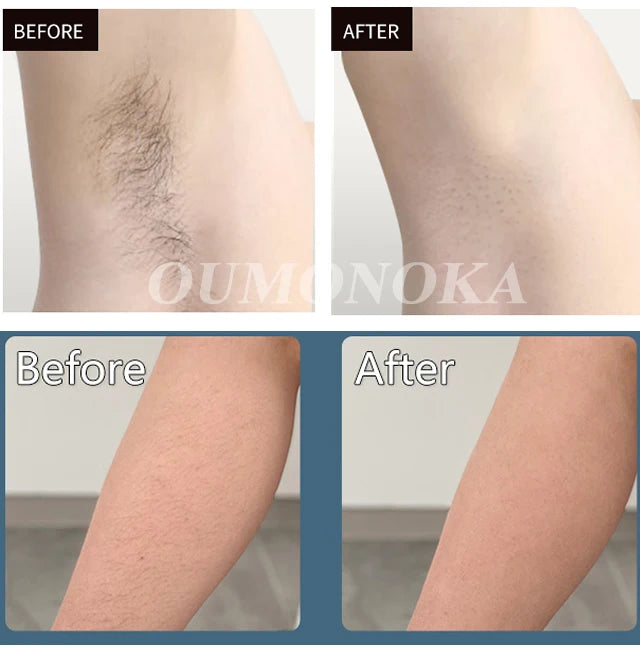 Before and after results of IPL hair removal